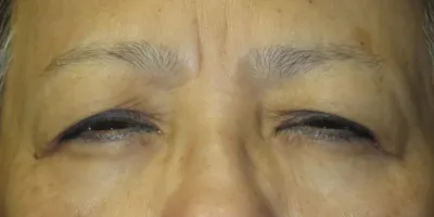 Upper Blepharoplasty